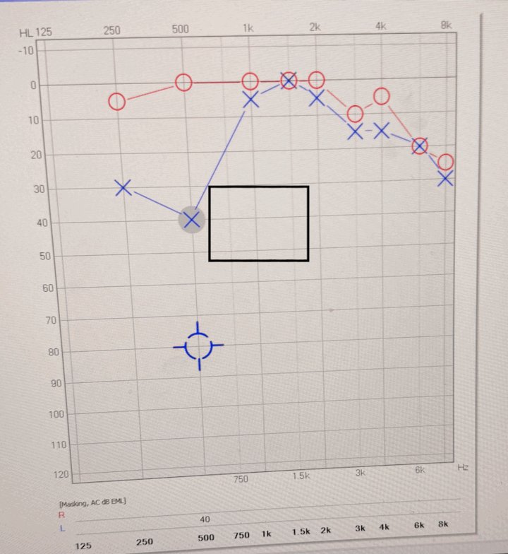 Clinical audiogram showing left-ear hearing thresholds on 23 July 2026: approximately 30 dB loss at 250 Hz and 40 dB at 500 Hz, recovering to near-normal threshold at 1 kHz and above
